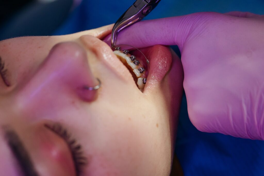 Young girl undergoing a dental procedure to have braces attached, capturing the precise moment of orthodontic treatment