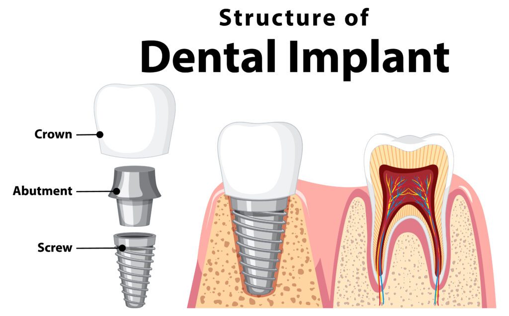 Infographic of human in structure of the dental implant