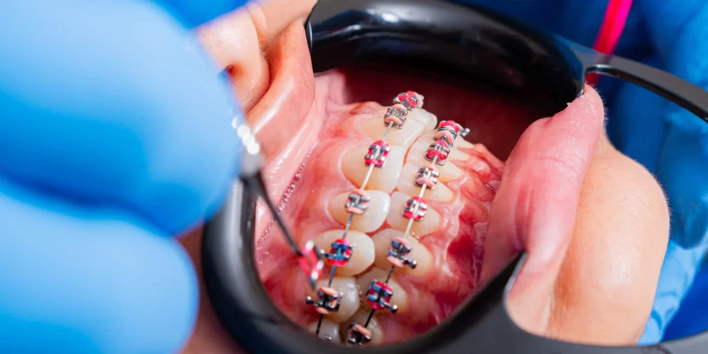 braces cost in the philippines guide