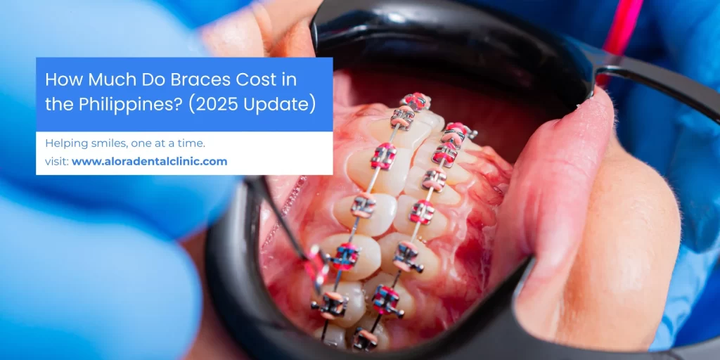 Close-up of dental braces on a patient’s teeth during treatment, used for Alora Dental Clinic’s 2025 guide on braces cost in the Philippines.