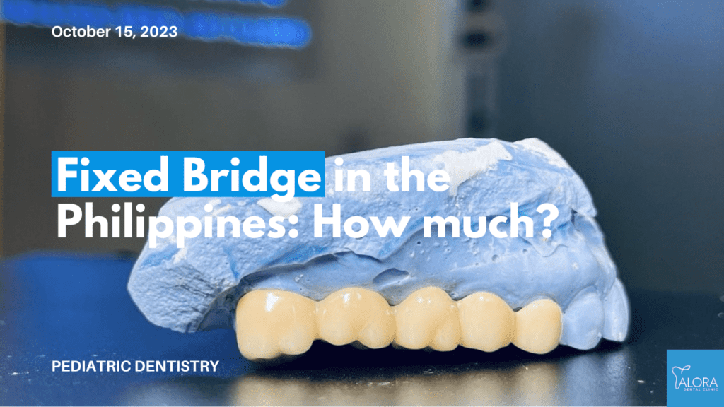 A detailed model of a fixed dental bridge from Alora Dental Clinic, Philippines, exemplifying the quality of dental replacements available