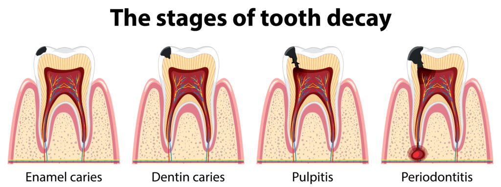 Dental Cavities 101: Causes, Prevention & Treatment