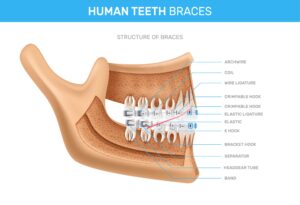 Metal Braces vs. Ceramic Braces: Which is Best? | Alora Dental