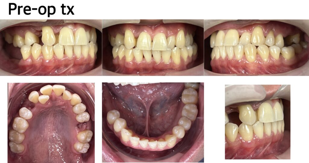 A set of close-up photographs from Alora Dental Clinic showing the teeth before any orthodontic treatment. The images capture the initial misalignment and dental condition, presenting frontal, top-down, and bottom-up views of the teeth.