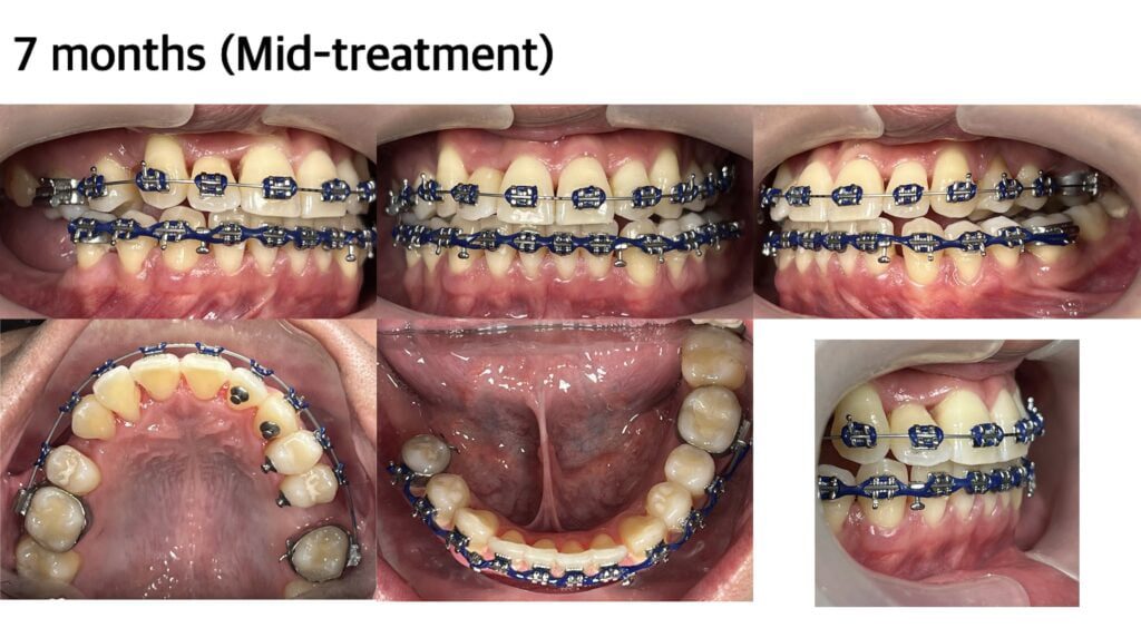 A set of close-up photographs from Alora Dental Clinic displaying teeth with blue braces from various angles, capturing the 7-month progress of orthodontic treatment. The images present a frontal view, top-down, and bottom-up perspectives, showcasing ongoing teeth alignment.