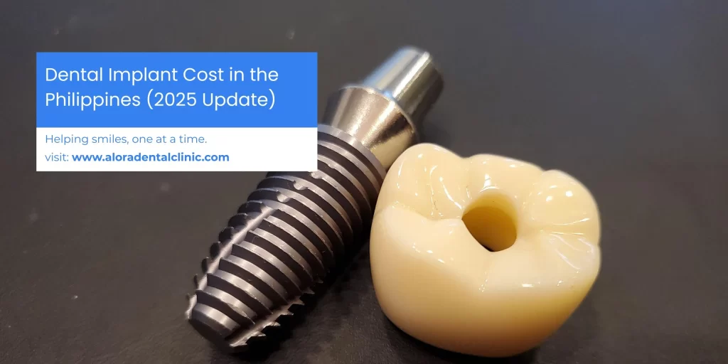 Blue and white banner showing dental implant graphics and text reading ‘Dental Implant Cost in the Philippines (2025 Update)’ for Alora Dental Clinic