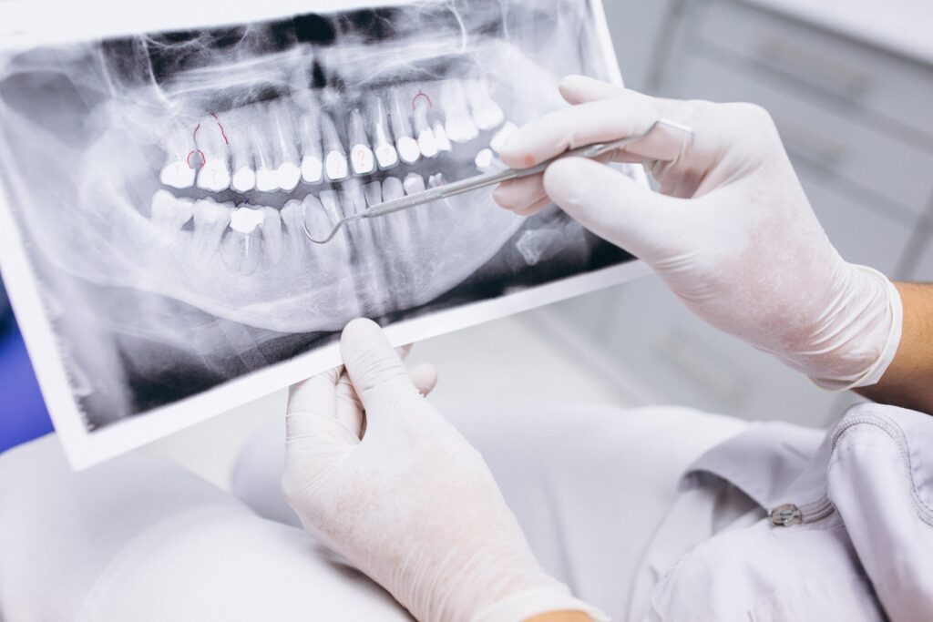 Close-up of a dentist's hands holding and analyzing a dental X-ray showing teeth with marked indications for potential root canal treatment.
