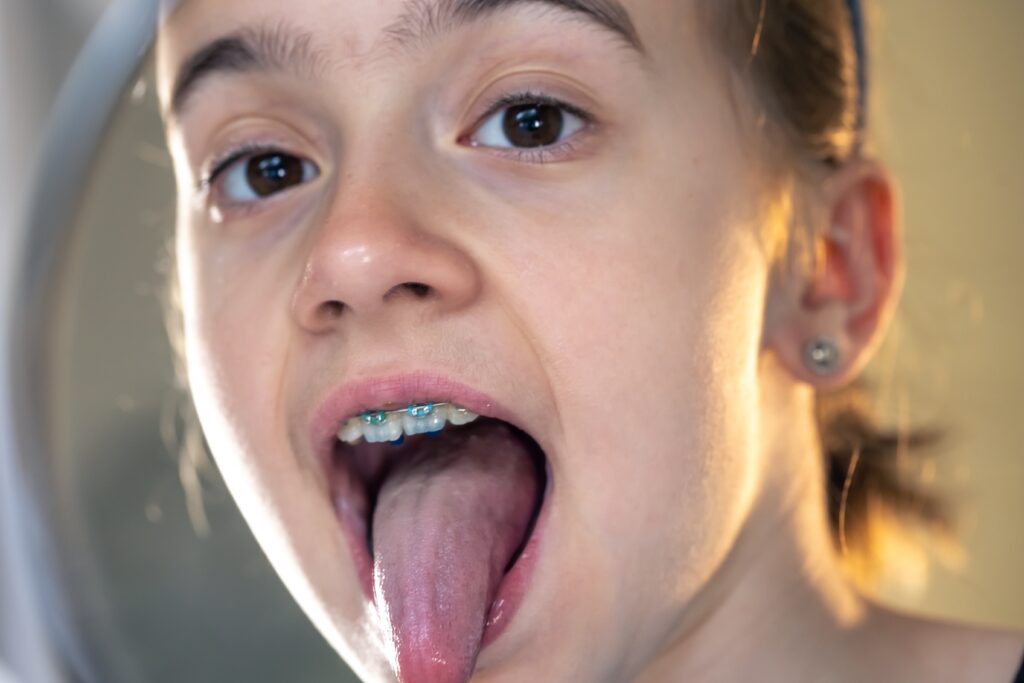 Young girl with dental braces sticking out tongue to check oral health in mirror, emphasizing importance of orthodontic care.