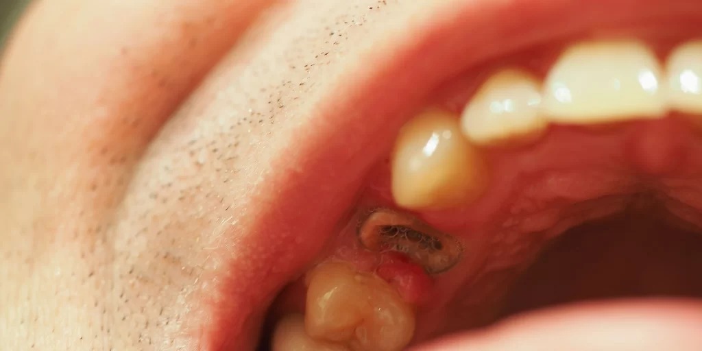 patient choosing between root canal or tooth extraction