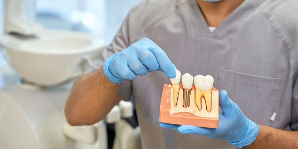 benefits-of-dental-implants-by-alora-dental-clinic