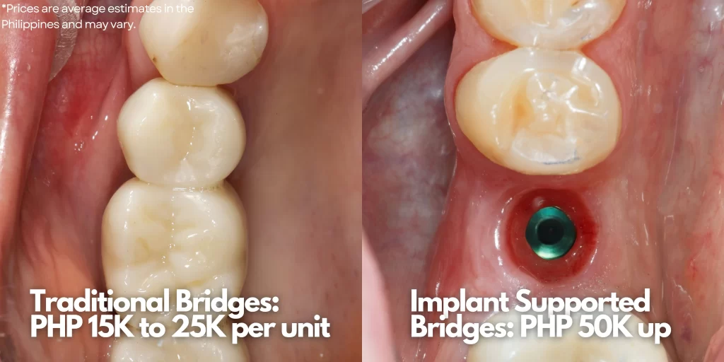 dental bridge cost comparison by alora dental clinic