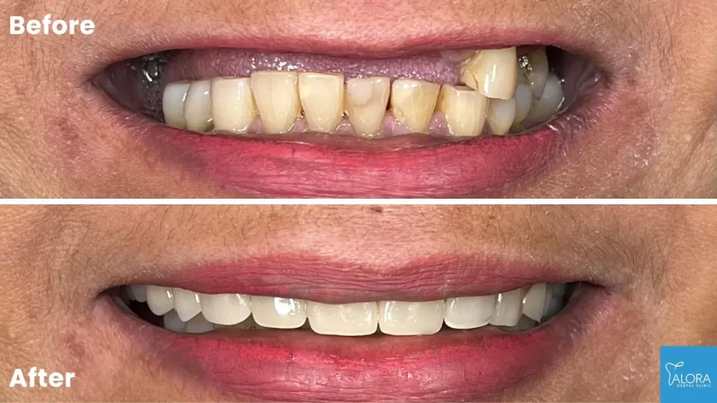 dentures before and after by alora dental clinic