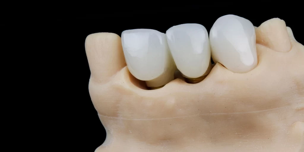 delaying dental bridge replacement