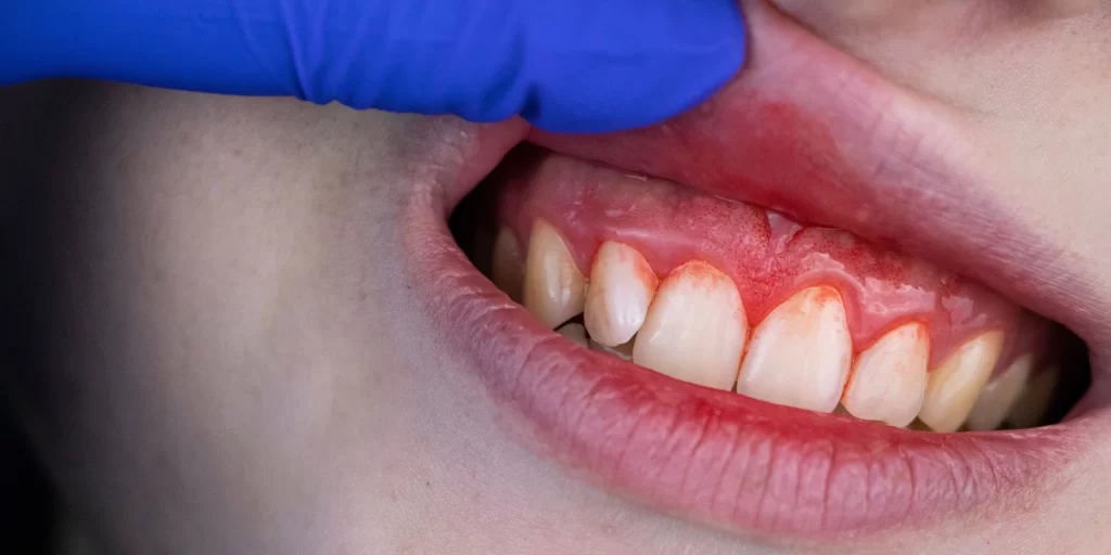 gum recession causes and prevention