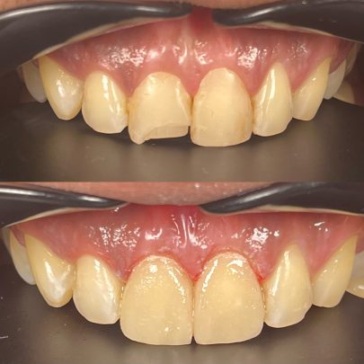 Veneers in Alora Dental Clinic