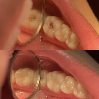 dental restoration (1) (1)