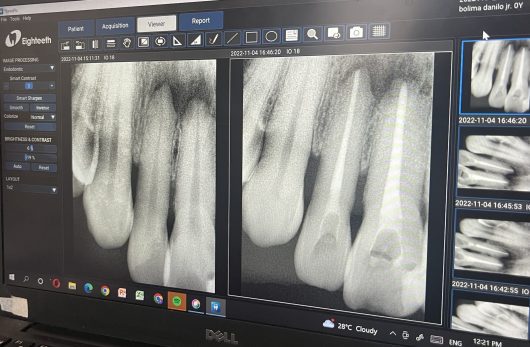 root canal surgery